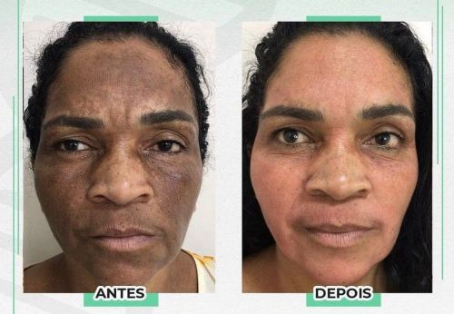 Queridinho Cicatridiva Clareamento 100% Natural e Aprovado pela Anvisa - Pagamento na entrega 724927